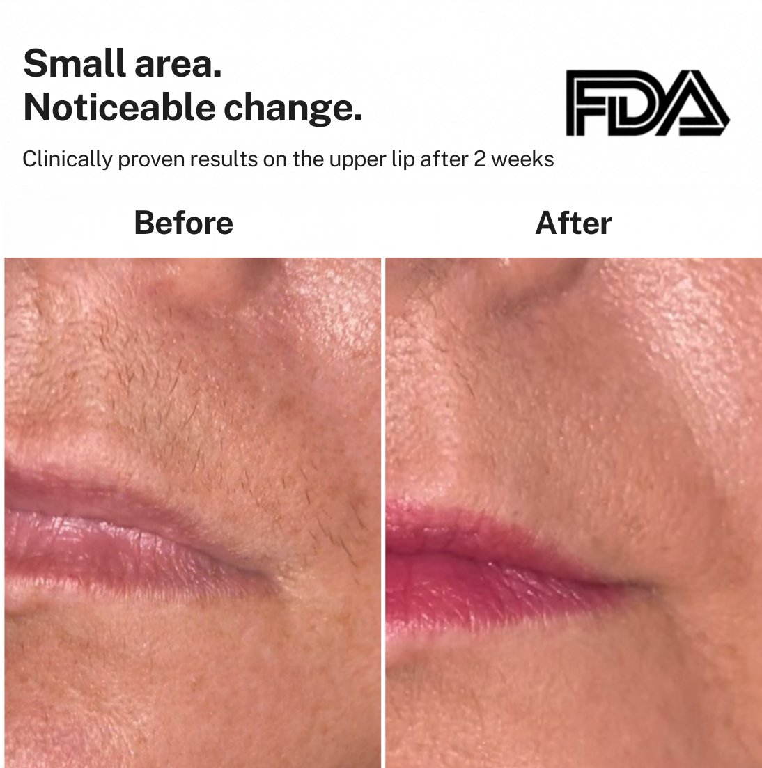 Smoothskin Ice cooling IPL