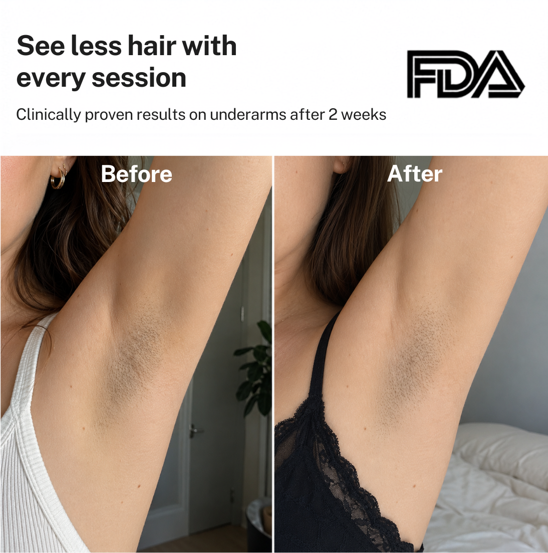 Smoothskin Ice cooling IPL