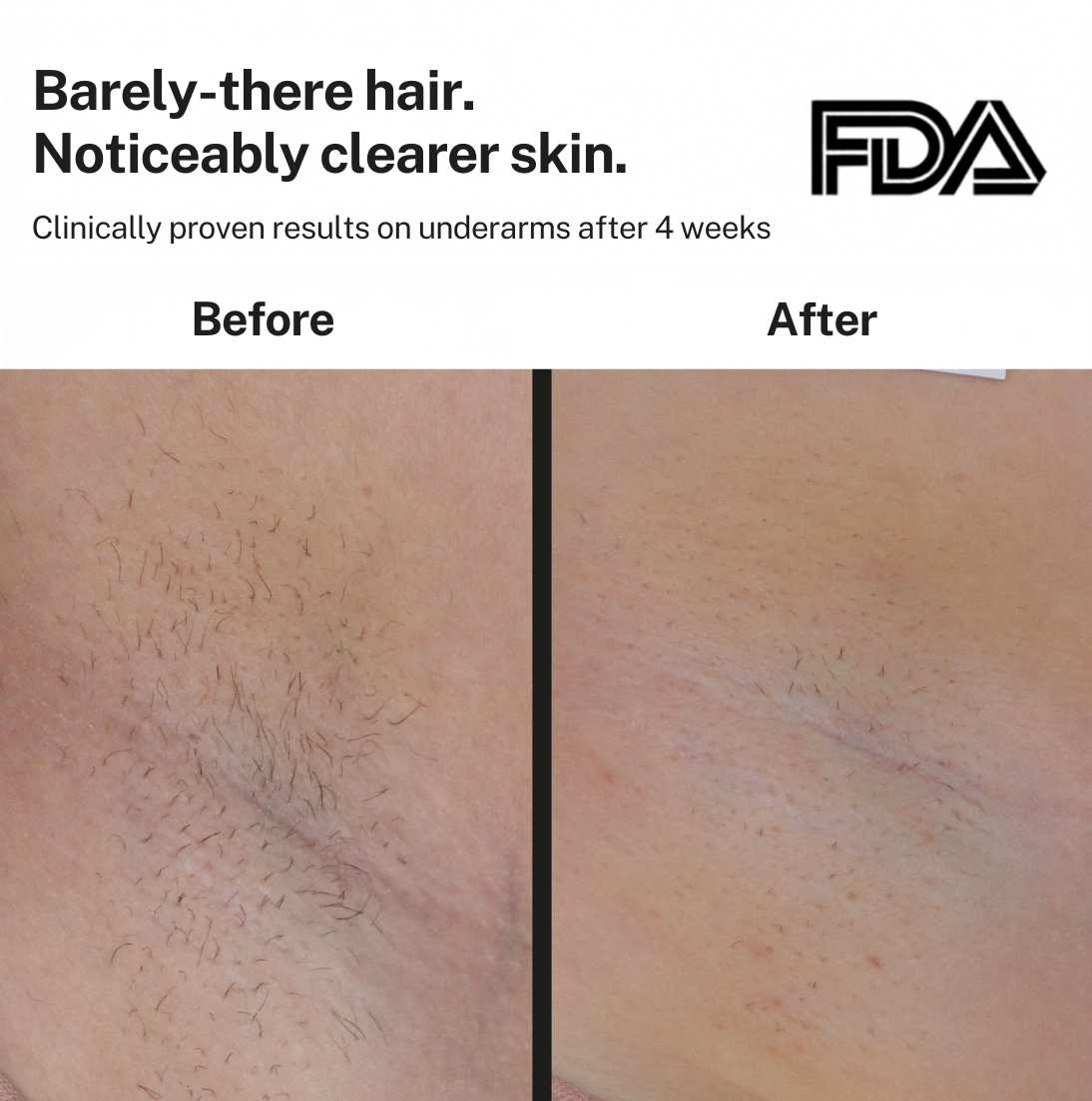 Smoothskin Ice cooling IPL