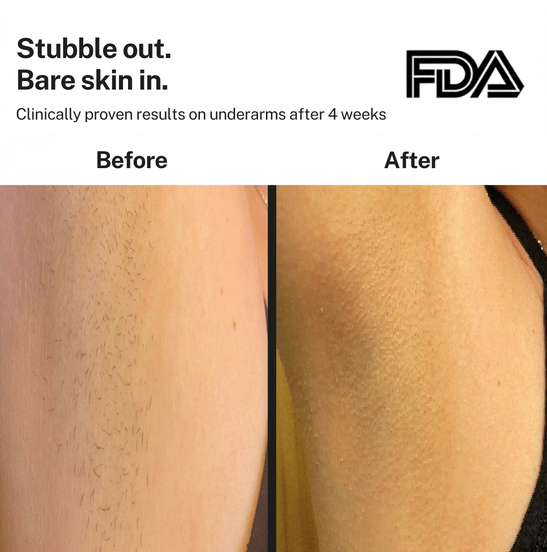 Smoothskin Ice cooling IPL