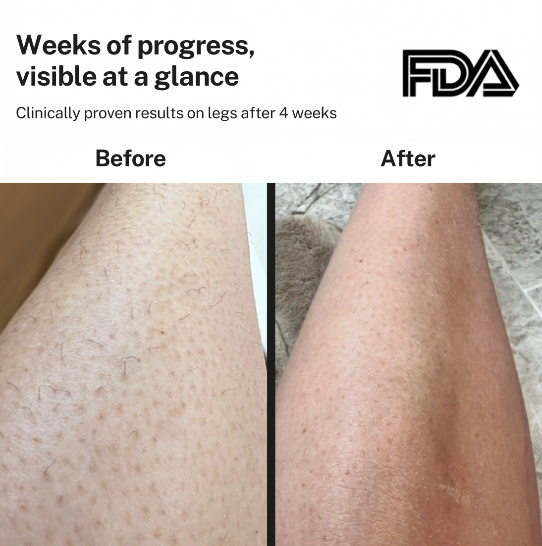 Smoothskin Ice cooling IPL