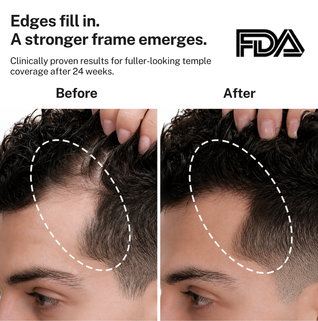 HairMax Laser Cap 272