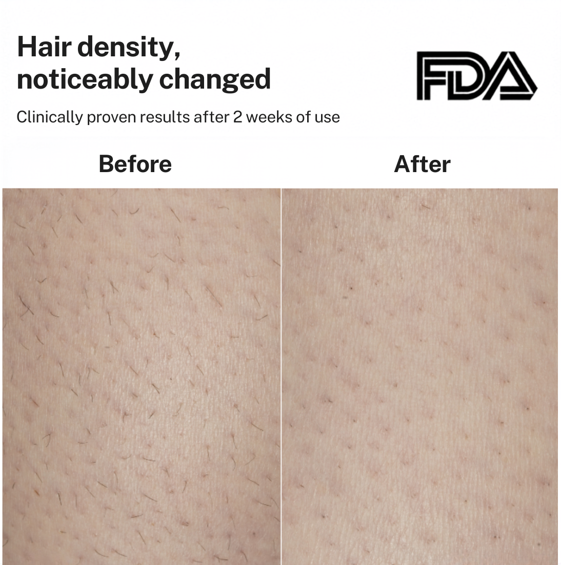 Smoothskin Ice cooling IPL