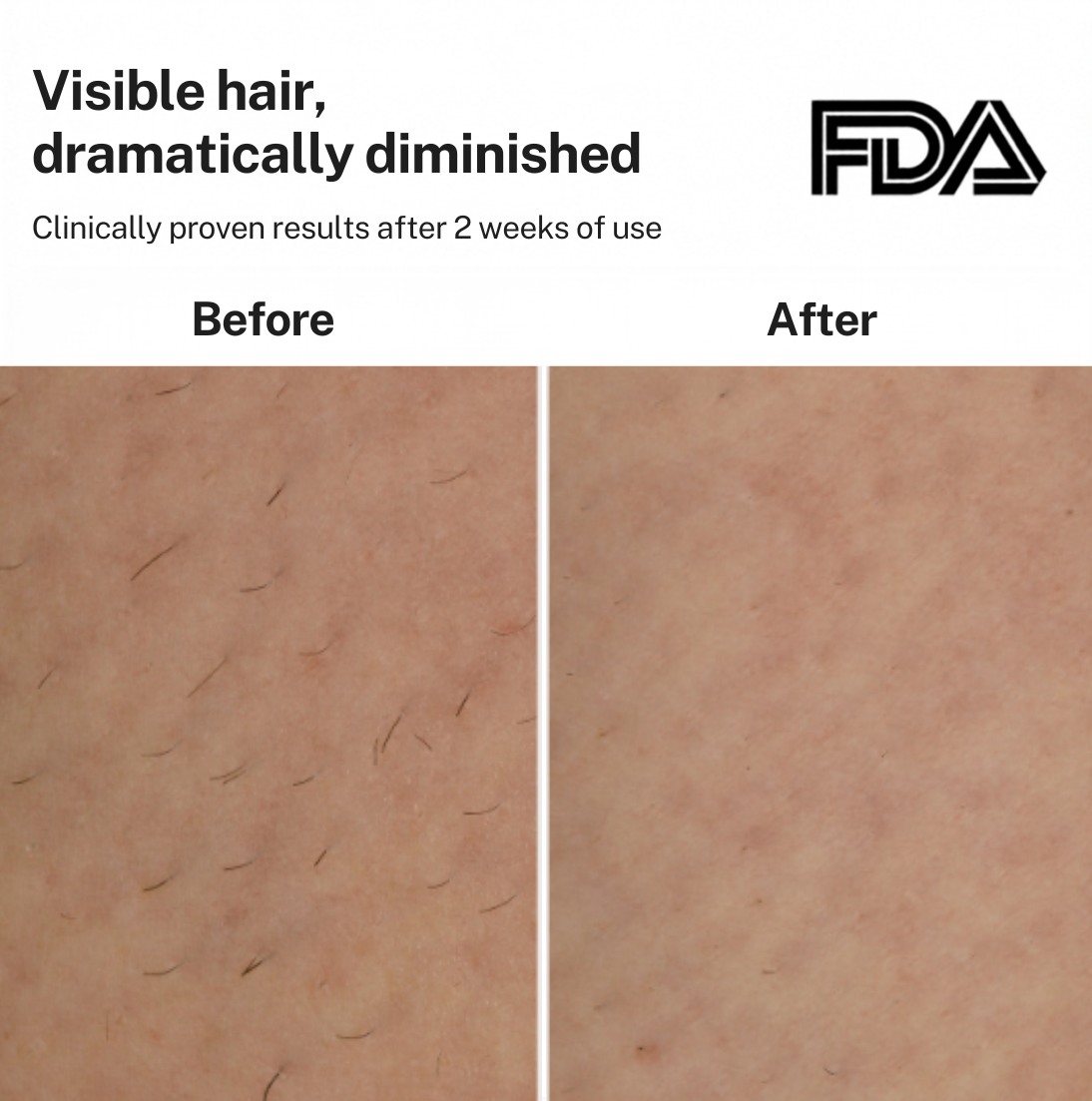 Smoothskin Ice cooling IPL