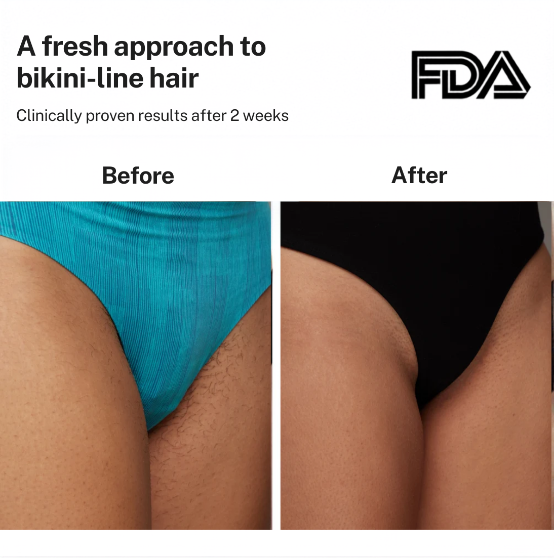Smoothskin Ice cooling IPL