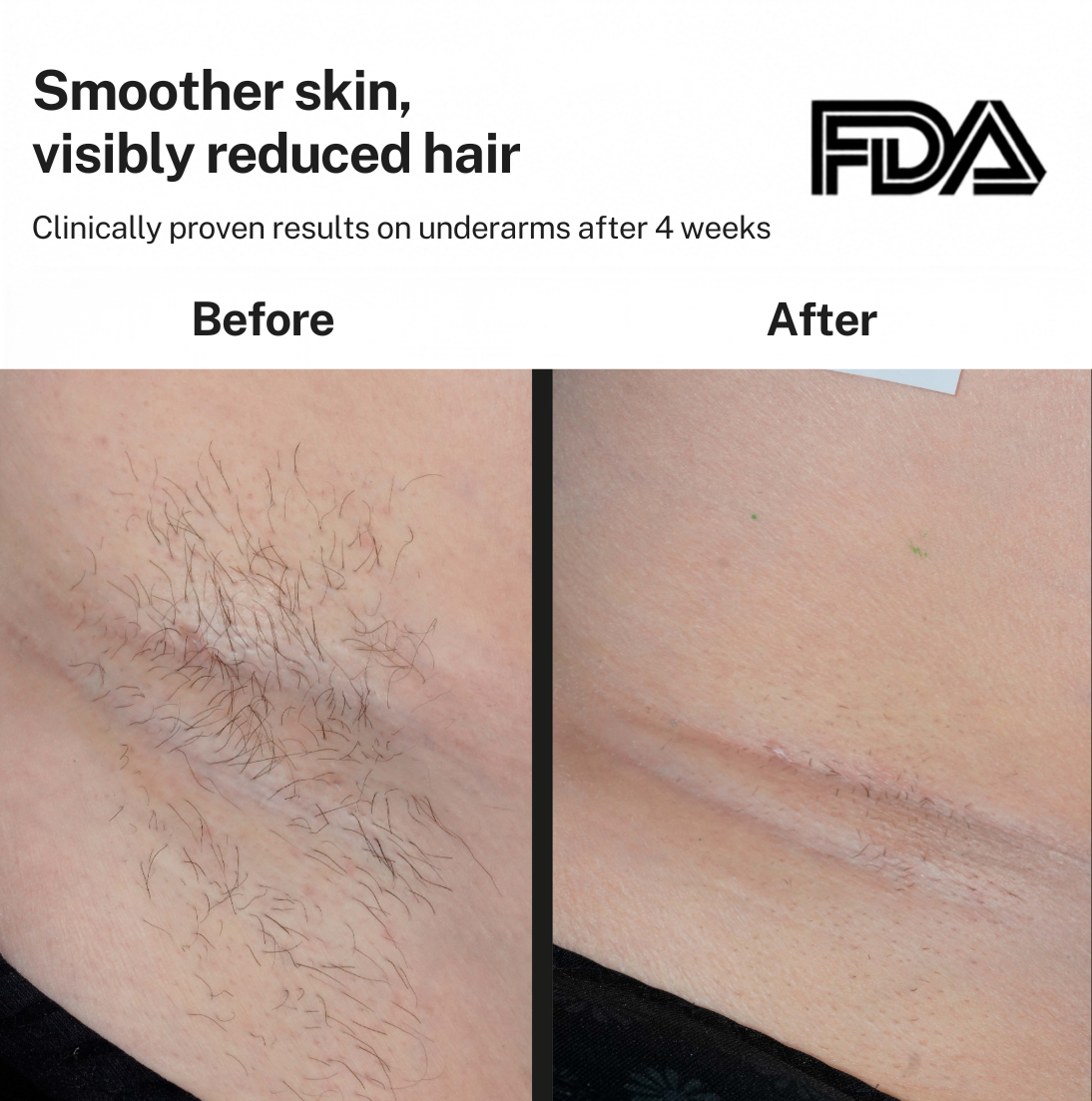 Smoothskin Ice cooling IPL