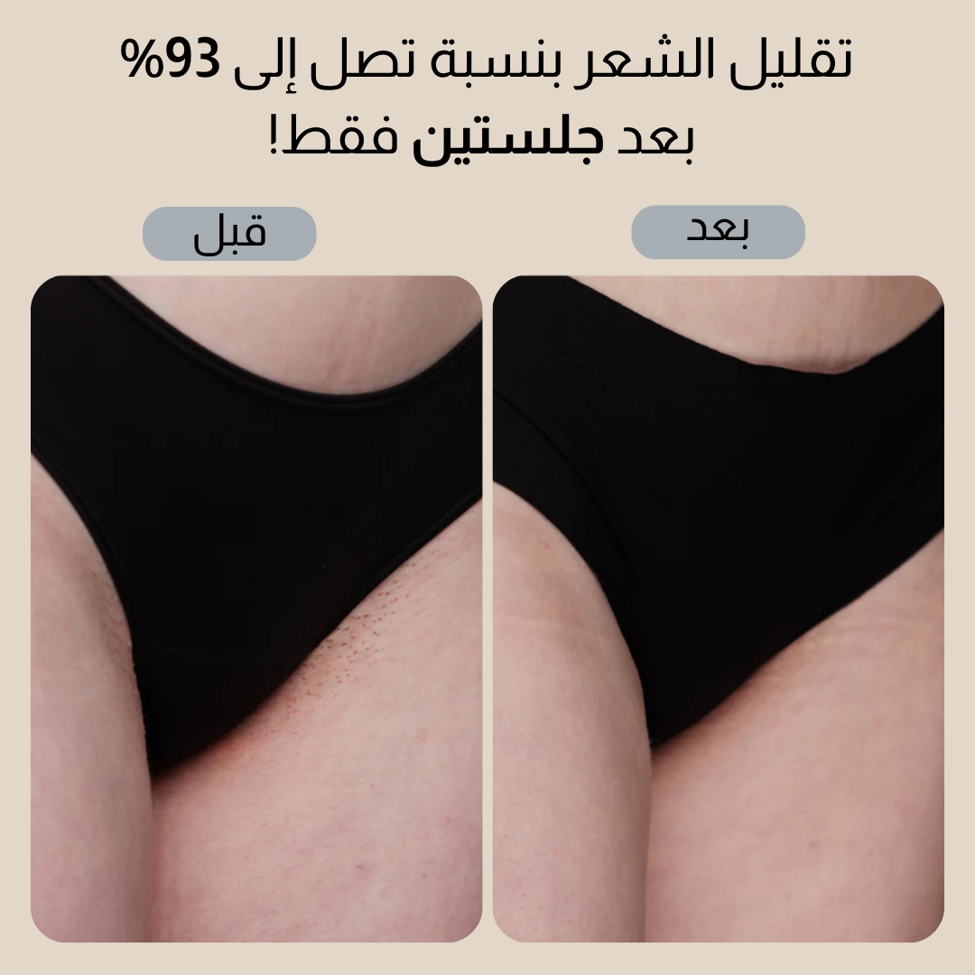 Smoothskin Ice cooling IPL