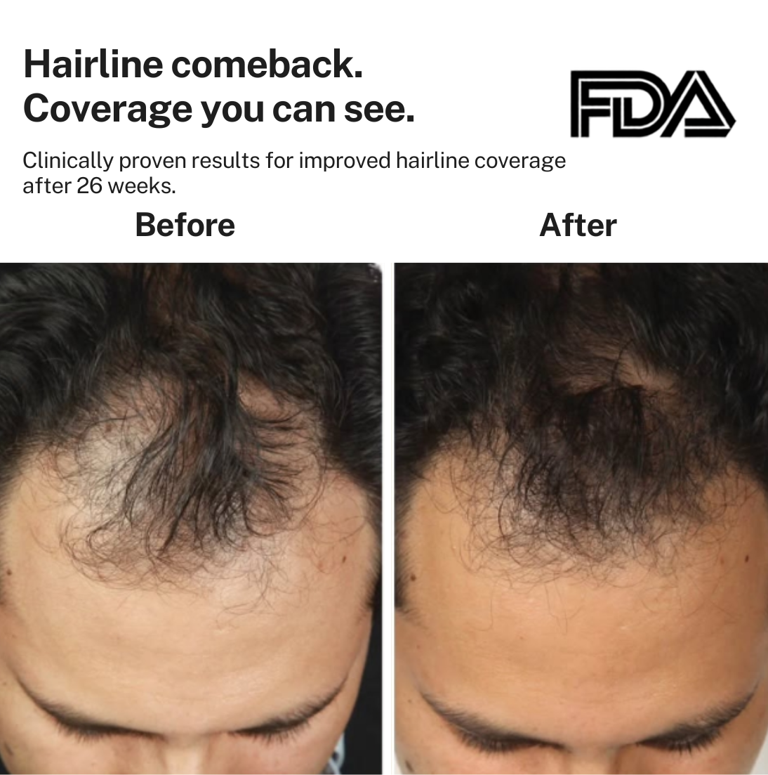HairMax Laser Cap 272