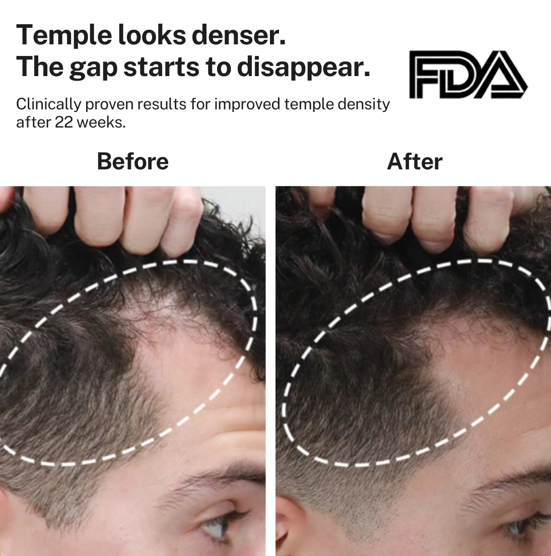 HairMax Laser Cap 272