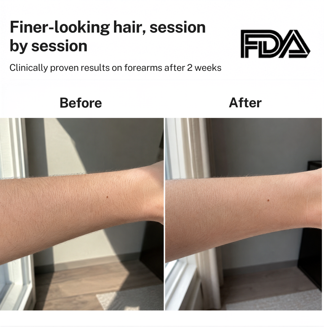 Smoothskin Ice cooling IPL
