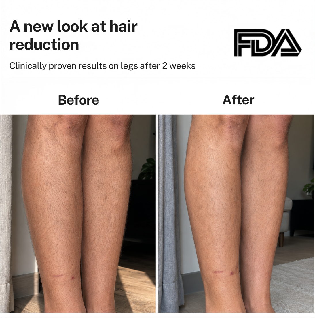 Smoothskin Ice cooling IPL