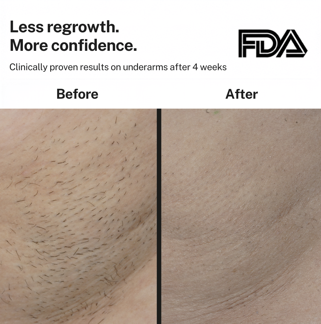 Smoothskin Ice cooling IPL